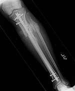 Follow-up tibia fracture.  Patient ambulating against advice. 