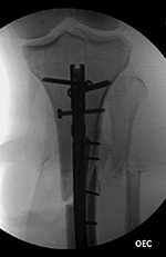 Fracture fixation with IM nail and supplementary plate and screws. AP view