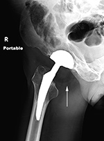 Right hip dislocation with liner displacement