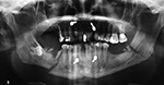 Mandible fractures