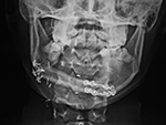 Mandibular reconstruction