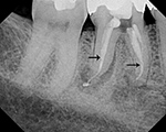 Root Canal