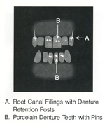 Root canals