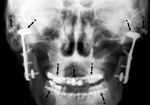 TMJ prosthesis