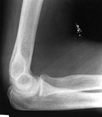 Mercury in the elbow