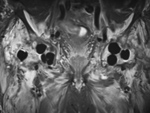 Hip antibiotic beads MRI coronal STIR image