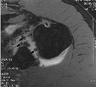 Shoulder MRI metallic artifacts