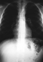 No visible foreign body