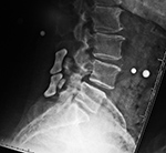 Interspinous clamps at L4-5