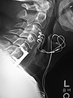 Bilateral vagus nerve stimulators