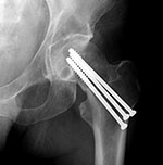 Hip cannulated cancellous fixation screws