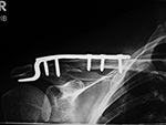 Clavicular hooked plate