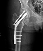 Dymanic hip screw