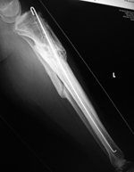 Tibial antibiotic rod