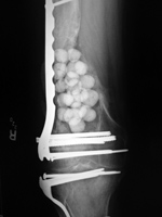 Antibiotic beads