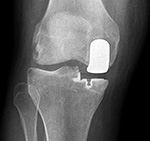 Unicompartmental knee prosthesis - AP view