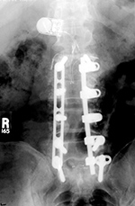 Bone stimulating unit