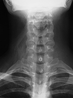 Hair overlying cervical spine and neck