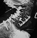 Cervical spine proud screw and gown snaps