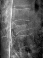 Vertebral compression fracture