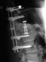 Expandable corpectomy device