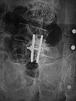 ILIF device