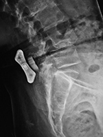 ILIF device
