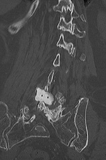 ILIF coronal CT image