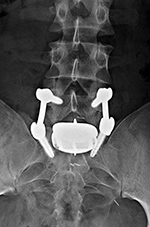 Lumbar disk replacement