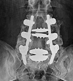 Lumbar spine fusion and metal-on-polyethylene disks