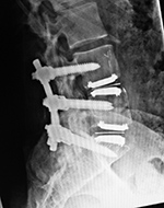 Lumbar spine fusion and metal-on-polyethylene disks
