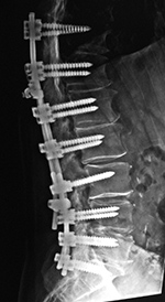 Lumbar spine pedicle screws and rods