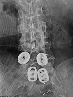 Lumbar spine disk spacers