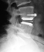 Metal-on-polyethylene disk replacement