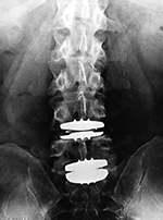 Lumbar spine total disk replacements at L4-5 and L5-S1