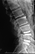 Lumbar spine total disk replacements at L4-5 and L5-S1