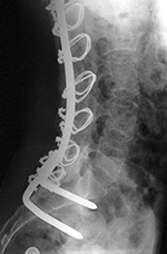 Luque rods lateral view