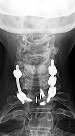 PEEK Prevail interbody device