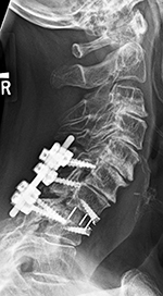 PEEK Prevail interbody device