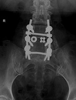 Posterior spinal fusion apparatus AP view