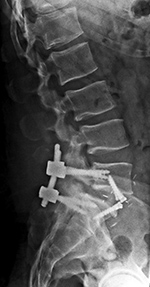 ALIF with PSF revision lateral view