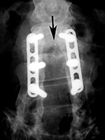 Steffee plates and screws with Branigan vertebral cage AP view
