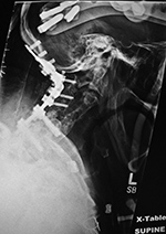 Posterior cervical fusion and halo brace