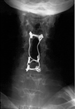 Posterior spine wiring