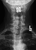 Posterior spinal wiring