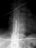 Spinal cord stimulator