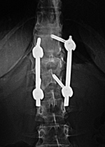 T12-L2 fixation
