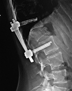 T12-L2 fixation
