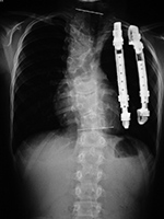 Expandable ribs
