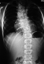 Severe congenital scoliosis before therapy